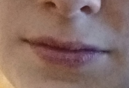 thumbnail of crusty and swollen lips 3.jpg