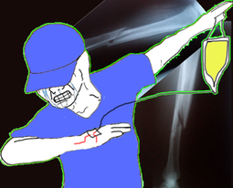 thumbnail of broken ligamx.PNG