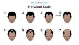 thumbnail of an-infographic-of-the-norwood-scale.jpg