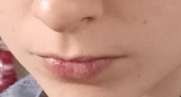 thumbnail of crusty and swollen lips 2.jpg