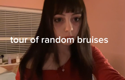 thumbnail of random bruise review.mp4