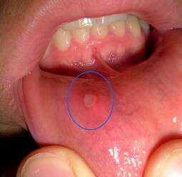 thumbnail of canker-sore-prevention-and-causes.jpg
