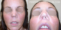 thumbnail of cocaine-nose-collapse-treatment.jpg