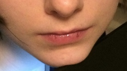 thumbnail of crusty and swollen lips 1.jpg