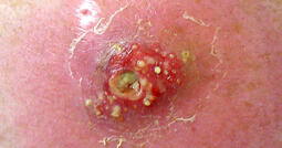 thumbnail of skin_infection_moran.jpg