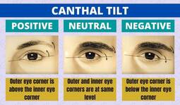 thumbnail of positive-neutral-negative-canthal-tilt.jpg