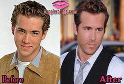 thumbnail of Ryan-Reynolds-Before-and-After-Plastic-Surgery.jpg